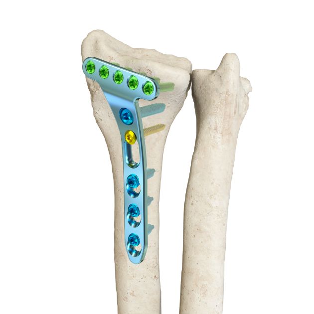 Locking Plate - Radius