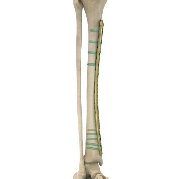 Locking Plate - Tibia