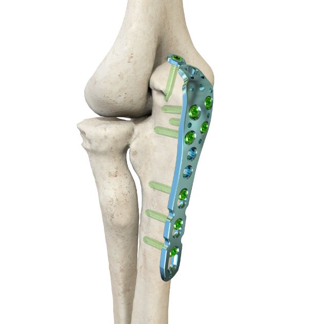 Locking Plate - Ulna