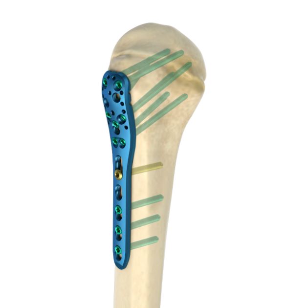 Locking Plate - Humerus