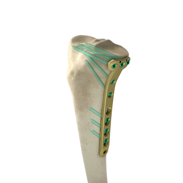 Locking Plate - Tibia