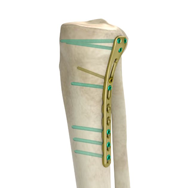 Locking Plate - Tibia