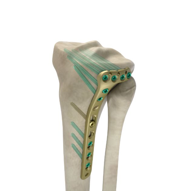 Locking Plate - Tibia