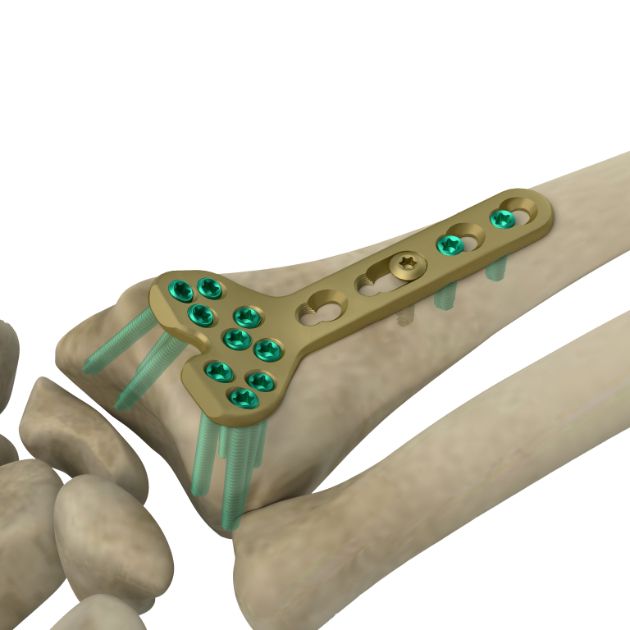 Locking Plate - Radius