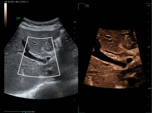 Product Teaser List 3 Cols PC - liver-cholangiocarcinoma-500x374