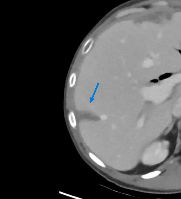 Infarction zone in segment 7/8 corresponding to the findings of the postoperative CEUS.