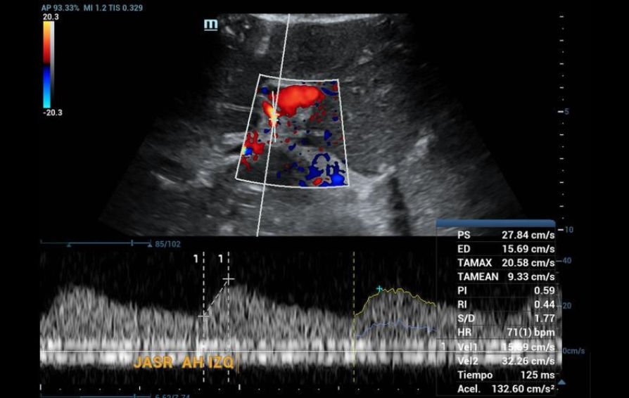 Doppler ultrasound, tardus parvus pattern in the left hepatic artery.