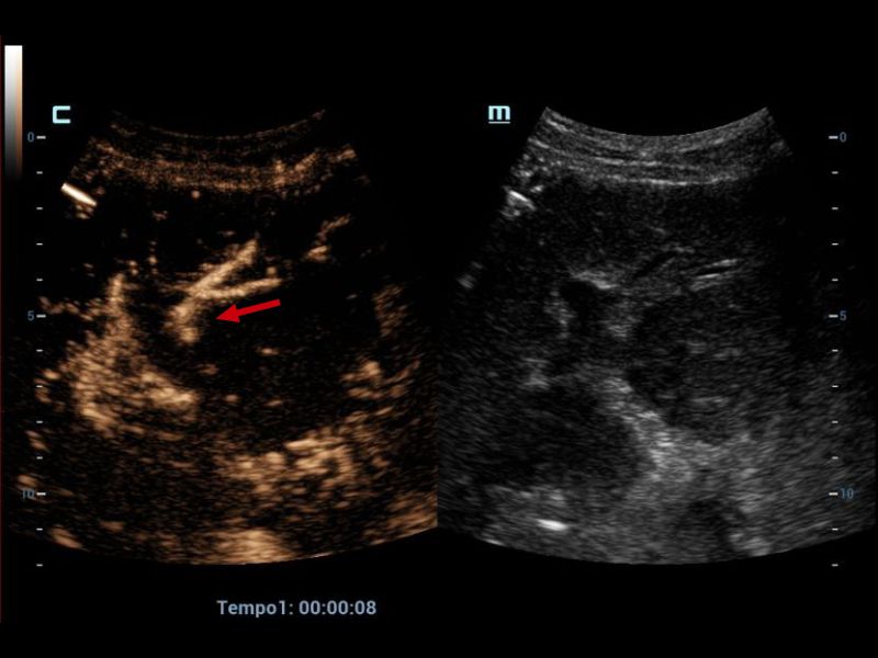 Left hepatic artery with adequate opacification (red arrow).