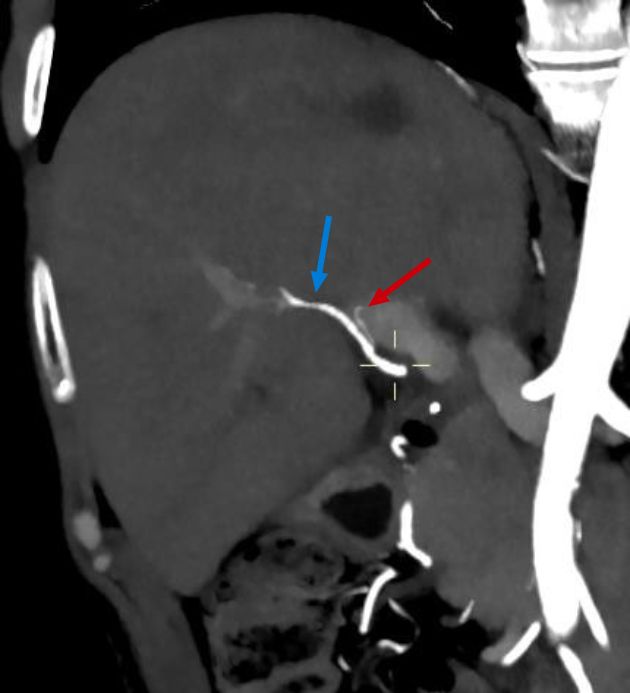 Patent hepatic artery of adequate caliber (blue arrow).