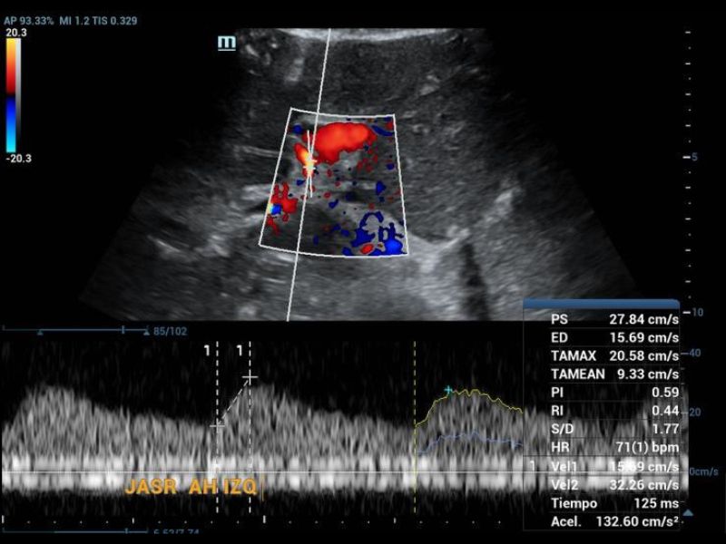 Doppler ultrasound, tardus parvus pattern in the left hepatic artery.