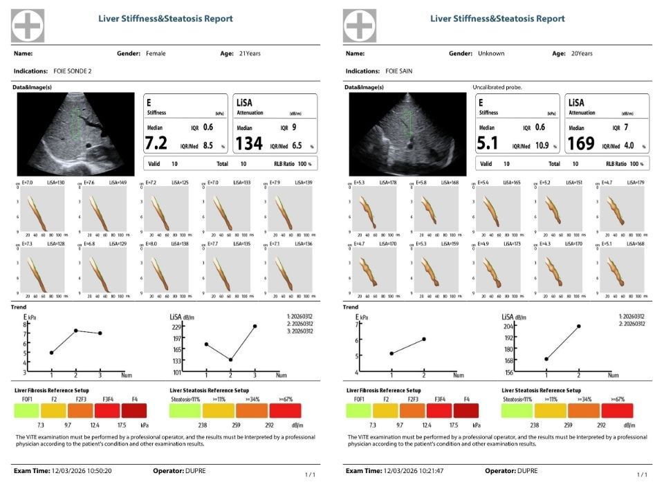 Liver Stiffness