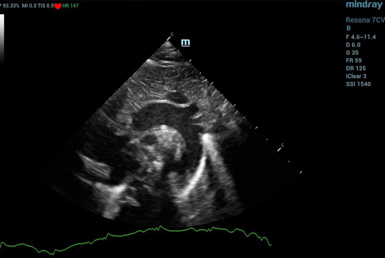 mindray-resona7-2D-imaging-of-the-aortic-arch-in-a-neonate