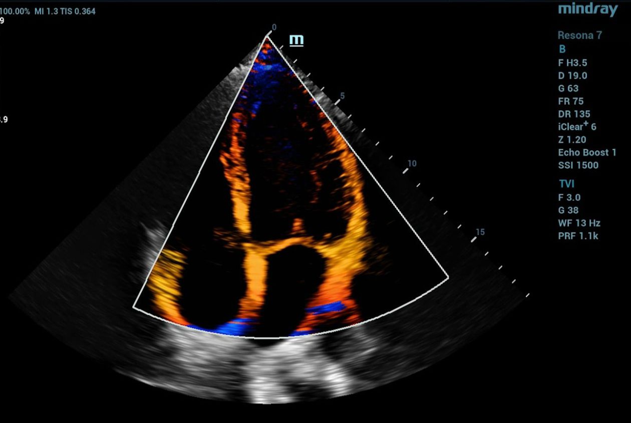 mindray-resona7-color-tissue-doppler-septal-lateral-annulus-motion