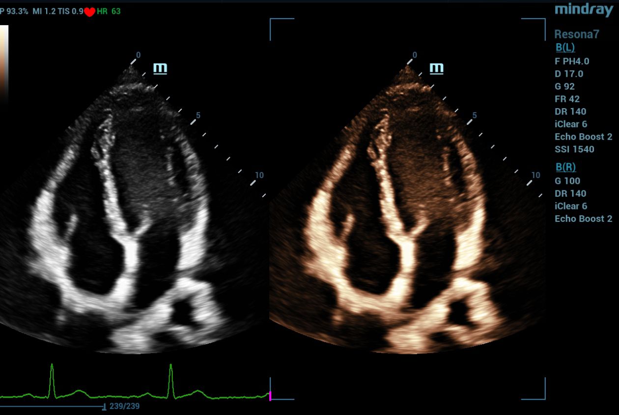 mindray-resona7-dual-live-cardiac-4-chamber-with-tissue-tint-maps