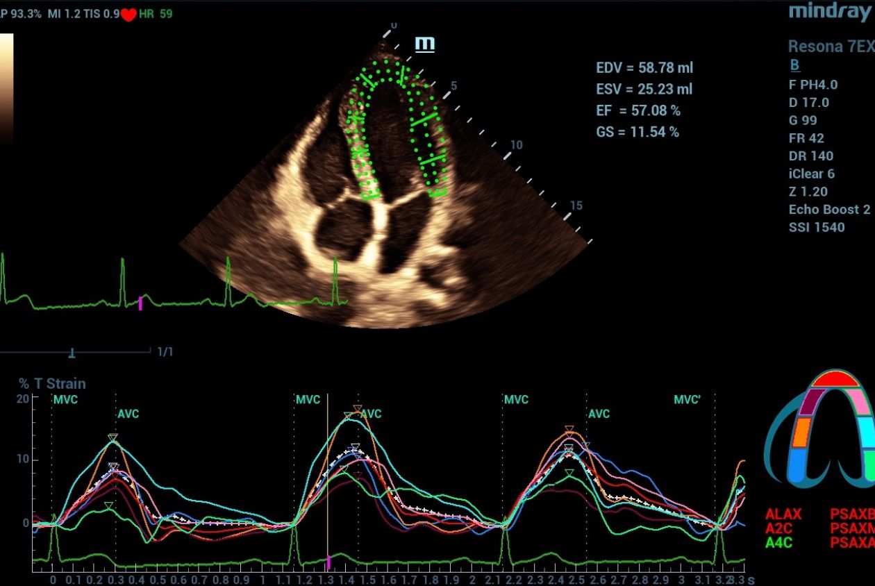 mindray-resona7-quantitative-strain-analysis-left-ventricle-tissue-tracking-qa