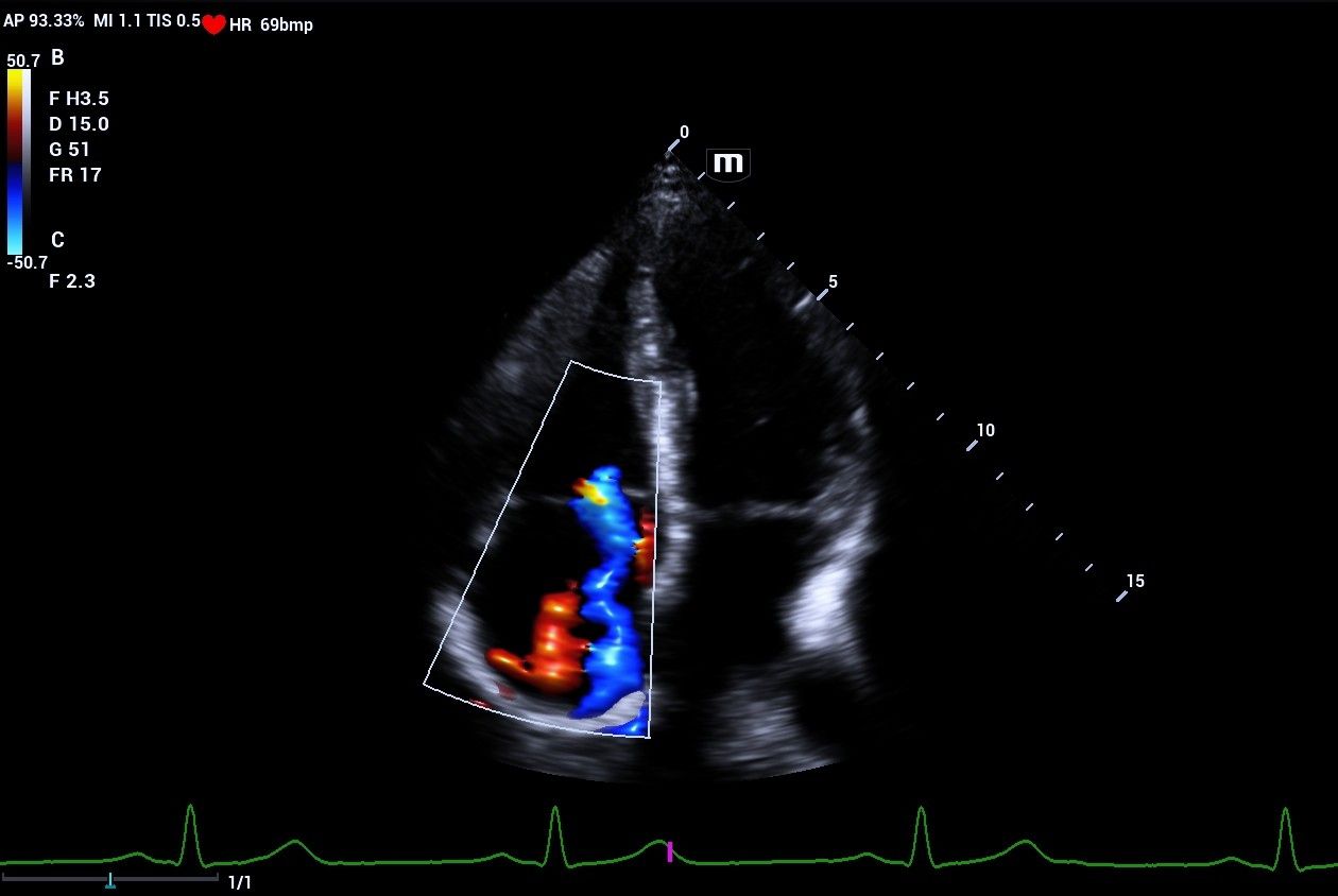 mindray-resonaI8-color-doppler-glazing-flow-tricuspid-valve-regurgitant-jet