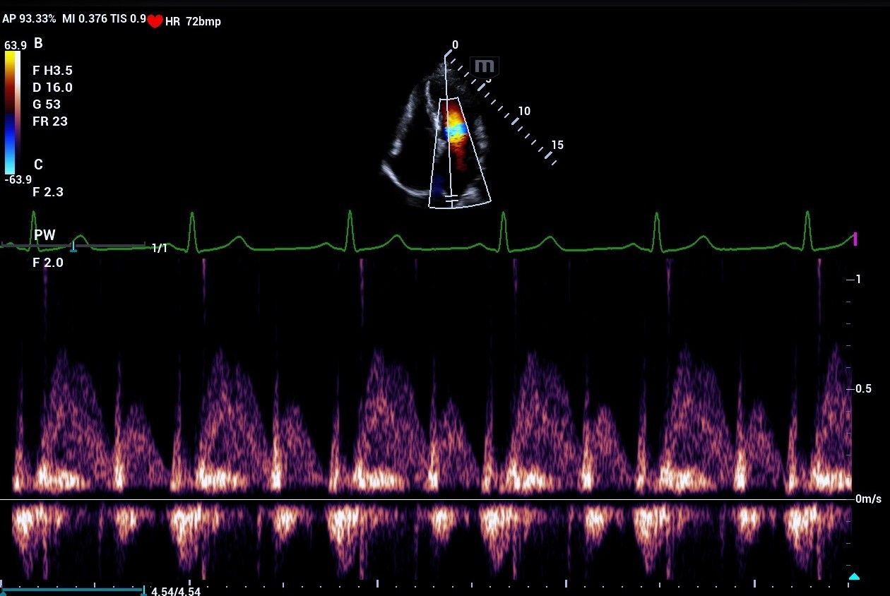 mindray-resonaI8-color-pulsedwave-doppler-mitral-inflow-velocities