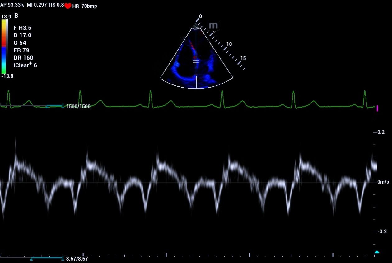 mindray-resonaI8-pulsed-tissue-doppler-imaging-septal-annulus-velocity