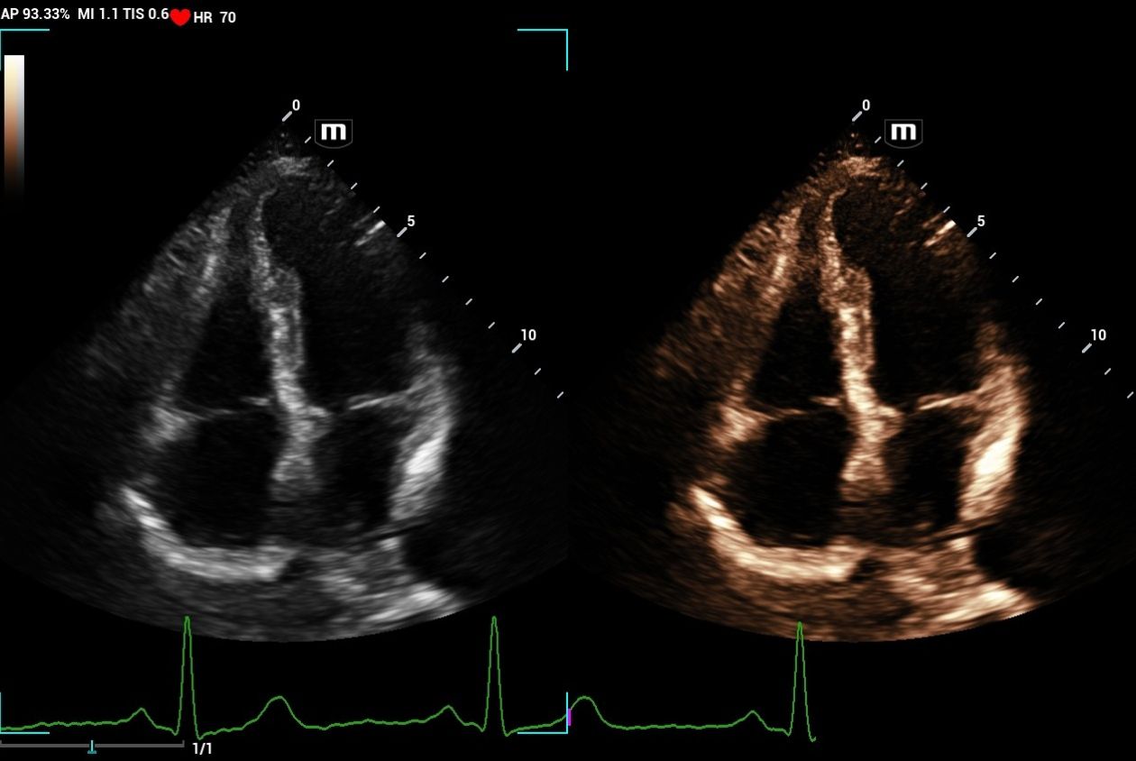 mindray-resonaI9-dual-live-apical-4-chamber