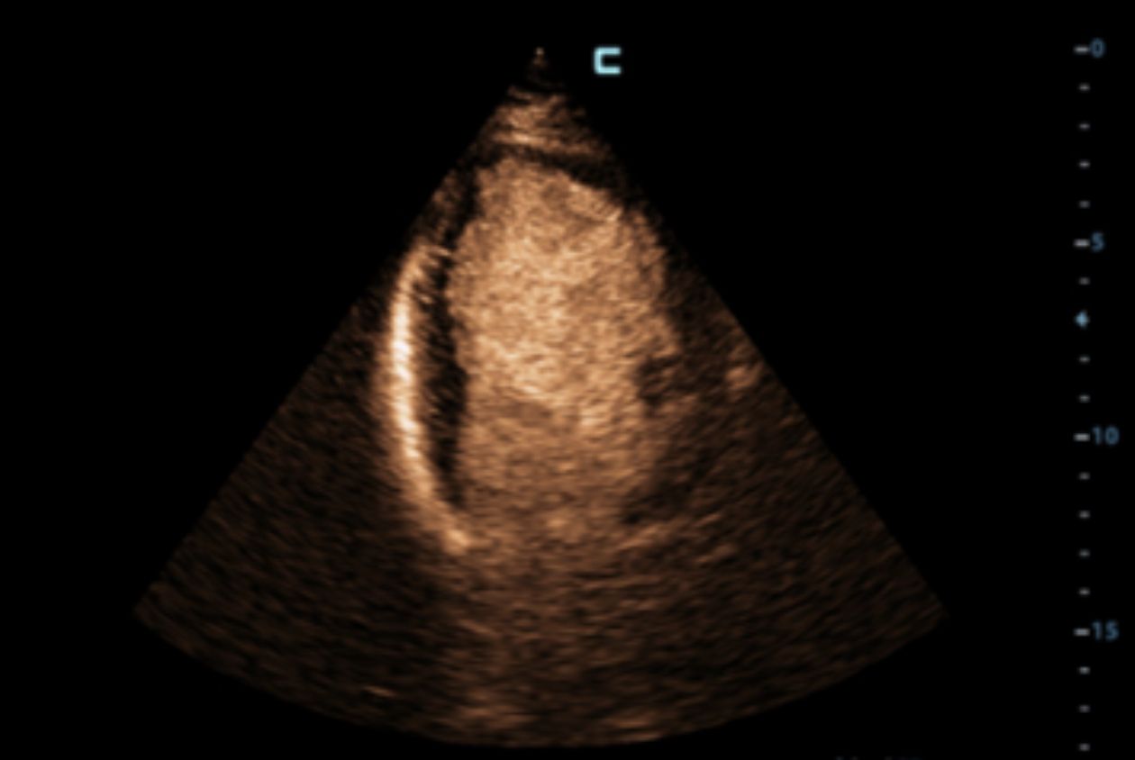 mindray-resonaI9-left-ventricular-opacification