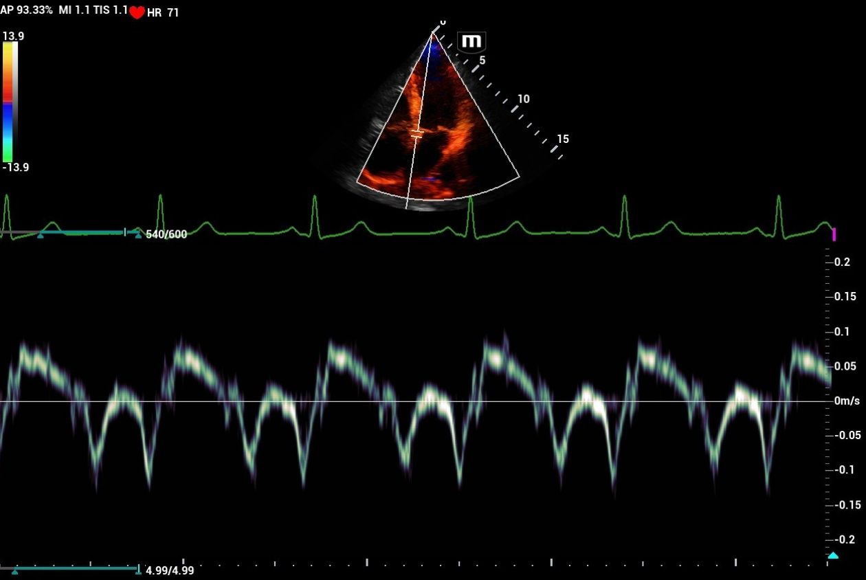 mindray-resonaI9-tissue-doppler-imaging-myocardium