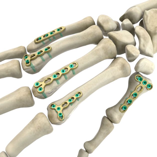 Locking Plate - Hand