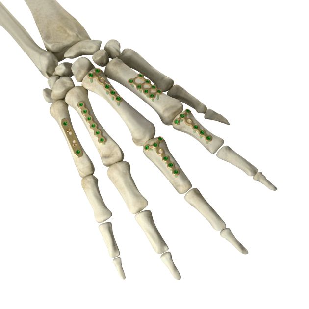 Locking Plate - Hand