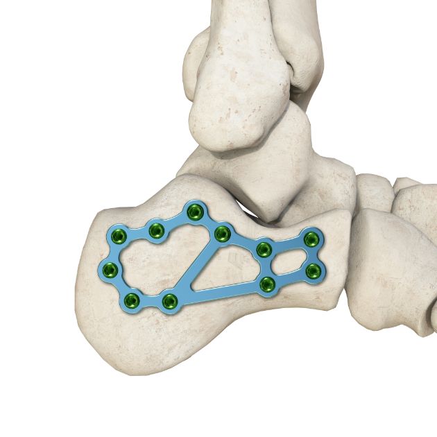 Locking Plate - Calcaneus