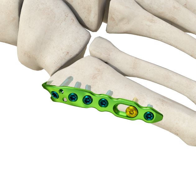 Locking Plate - Foot