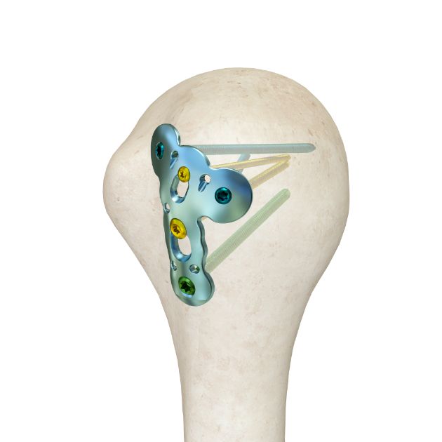 Locking Plate - Humerus