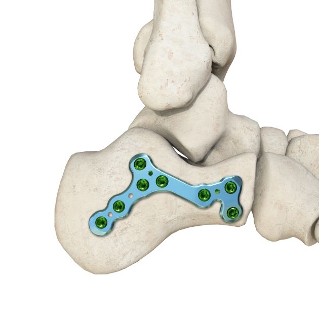Locking Plate - Calcaneus