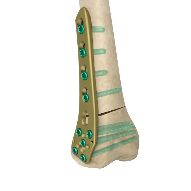 Locking Plate - OSTO