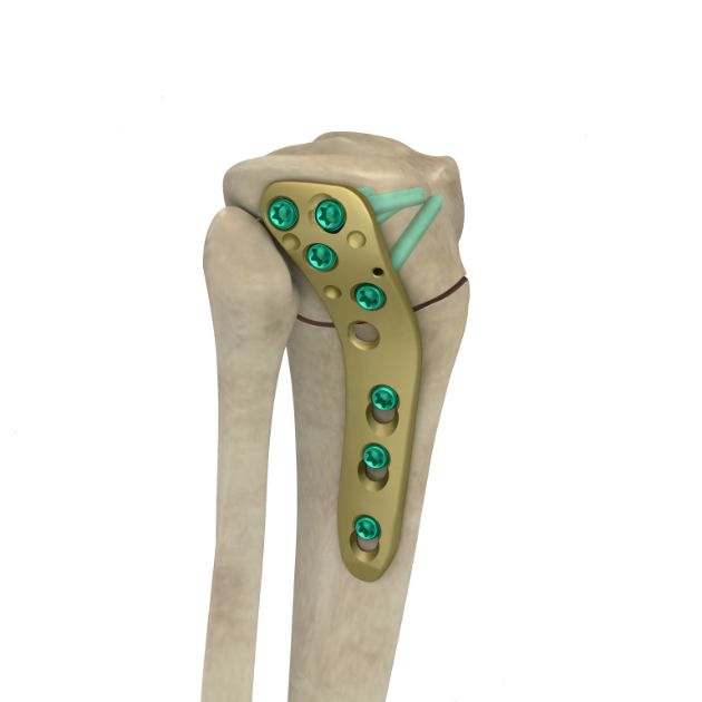 Locking Plate - OSTO