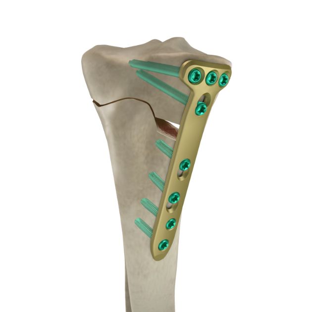 Locking Plate - OSTO