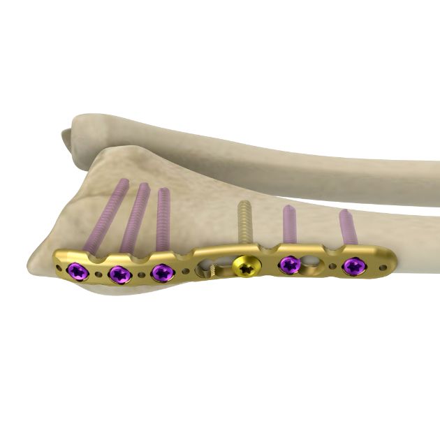 Locking Plate - Radius