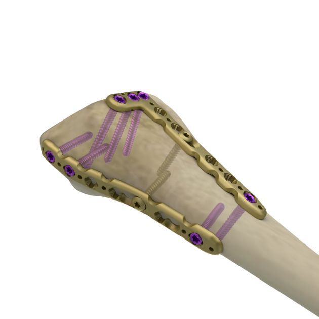 Locking Plate - Radius