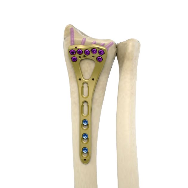 Locking Plate - Radius