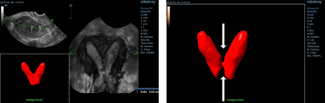 complete septate uterus and cervix