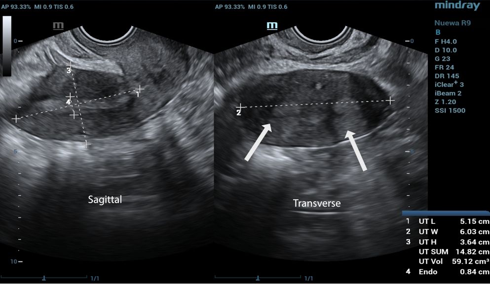 Sagittal vs trasnverse view for normal vagina ultrasound exmanination 