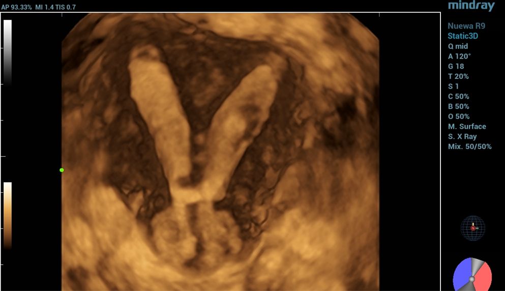 complete septate uterus with septate cervix