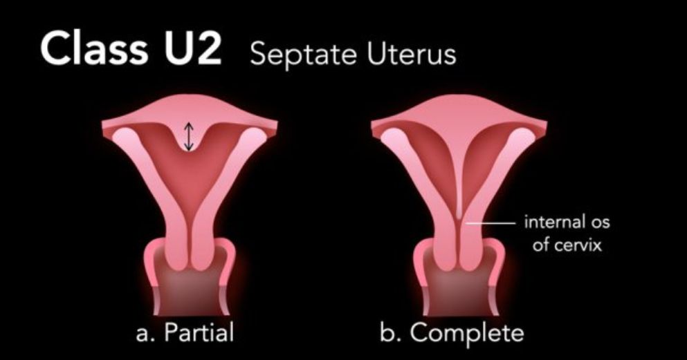 Class U2 - Septate Uterus for partial and complete