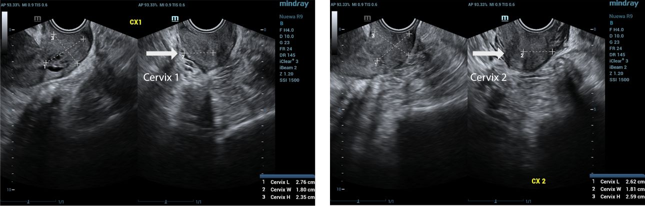 two endocervical cavities noted