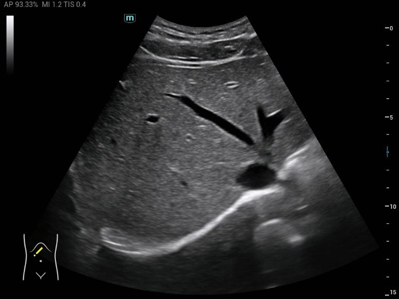 MX3 Compact Ultrasound System - Clinical Image - Abdomen