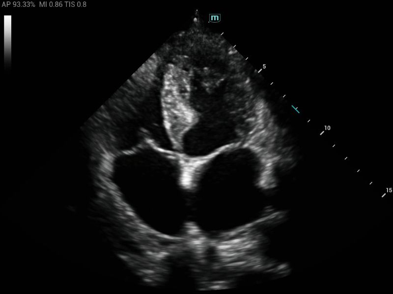 MX3 Compact Ultrasound System - Clinical Image - Cardiology