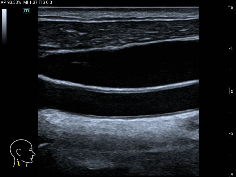 MX3 Compact Ultrasound System - Clinical Image - Carotid