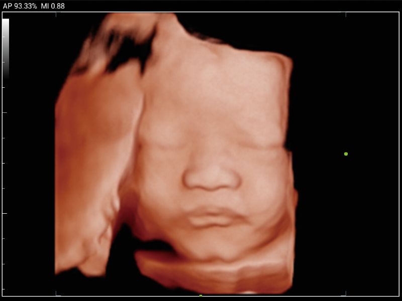 MX3 Compact Ultrasound System - Clinical Image - Fetus