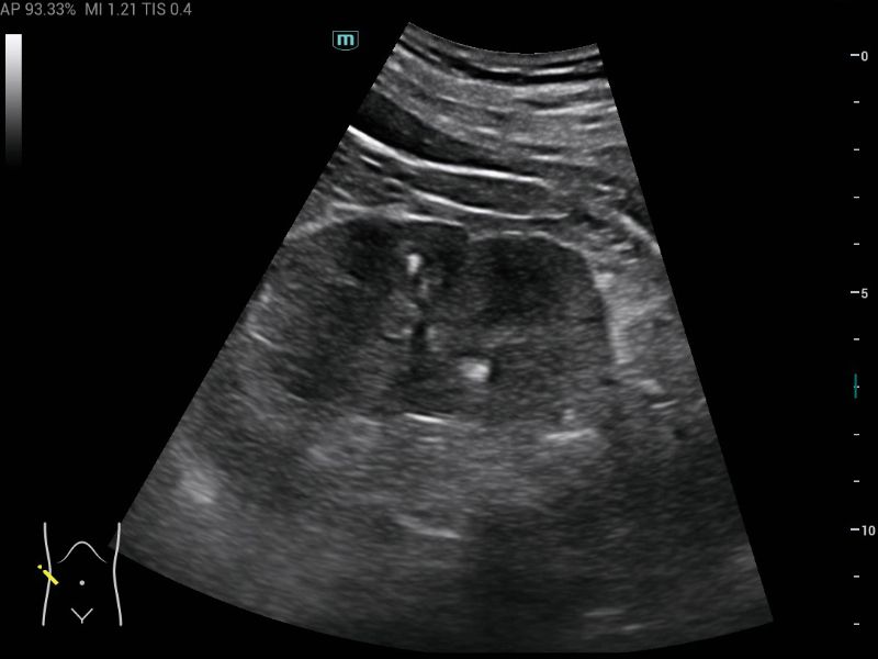 MX3 Compact Ultrasound System - Clinical Image - Kidney