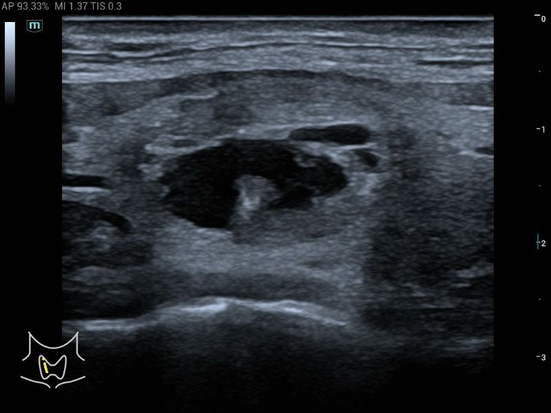 MX3 Compact Ultrasound System - Clinical Image - Thyroid