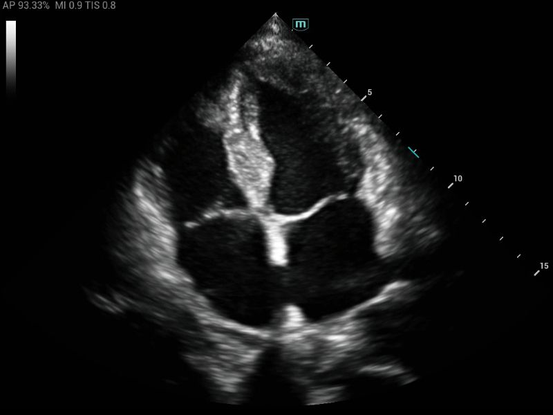 MX5 Compact Ultrasound System - Clinical Image - Cardiology