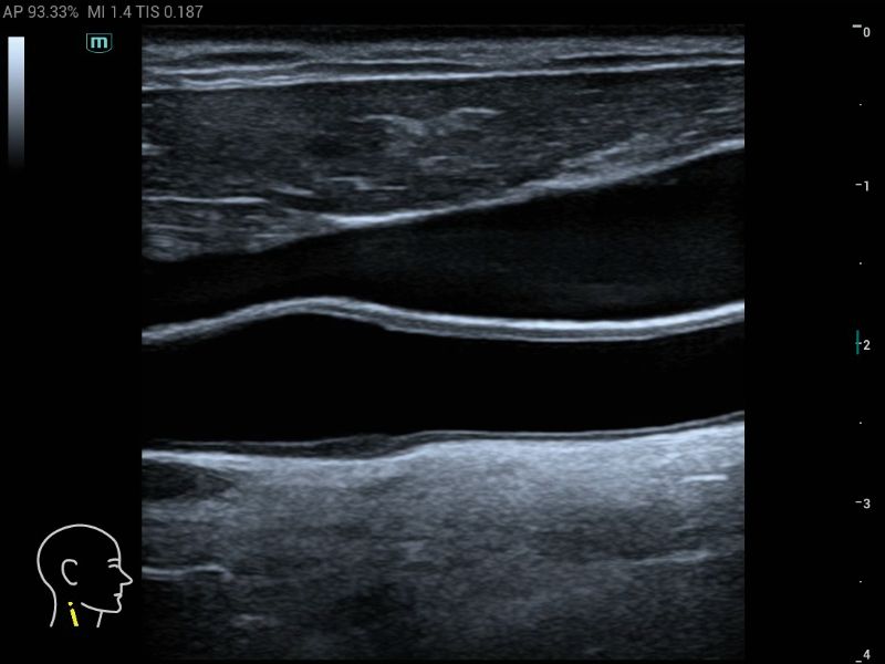 MX5 Compact Ultrasound System - Clinical Image - Carotid